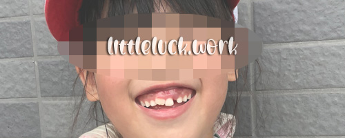 術前の歯並び写真