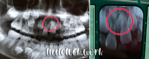 過剰歯のレントゲン写真